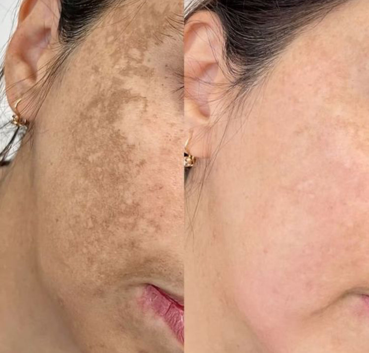 Traitements Anti Taches